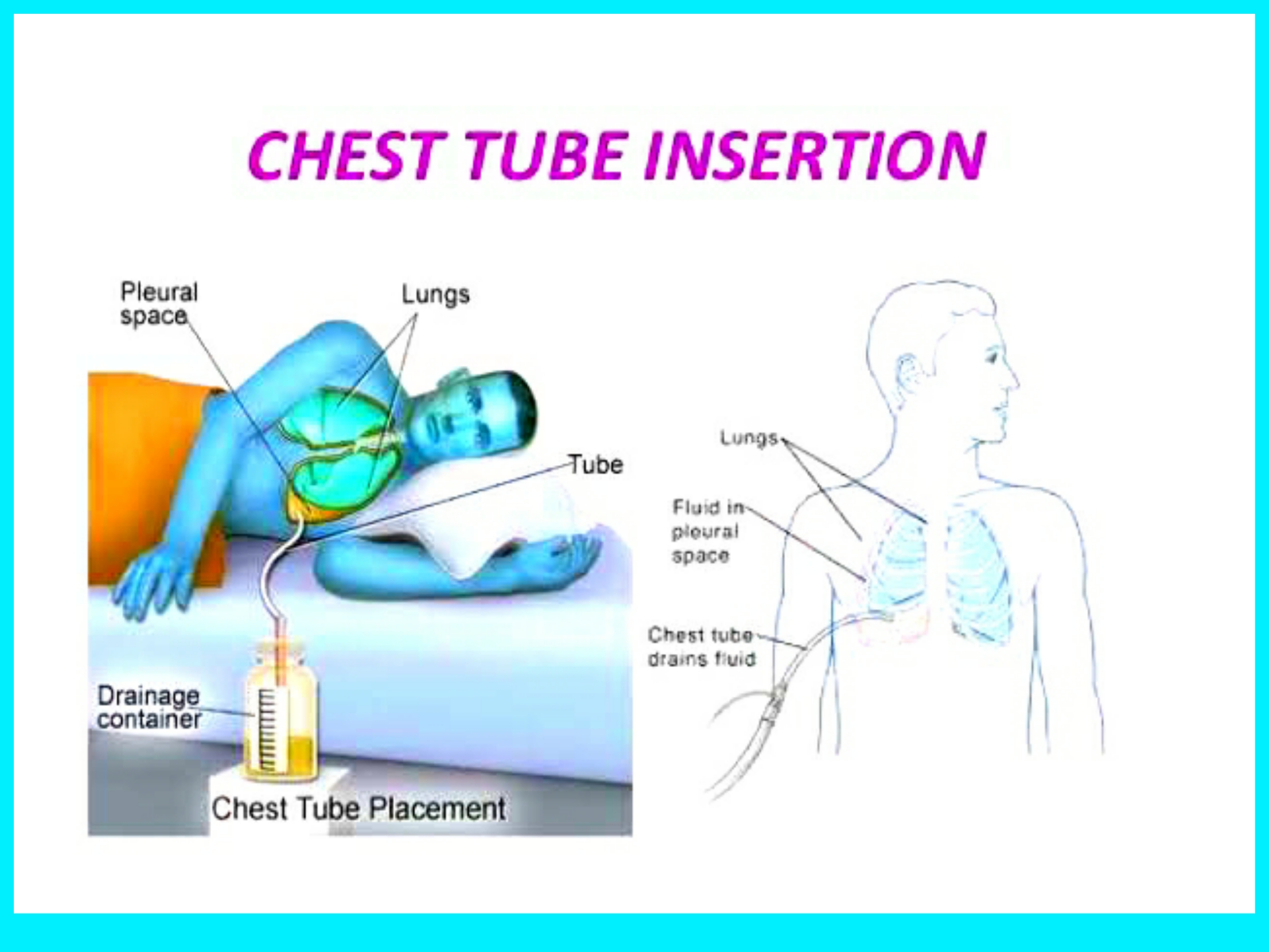chest tube case study nursing