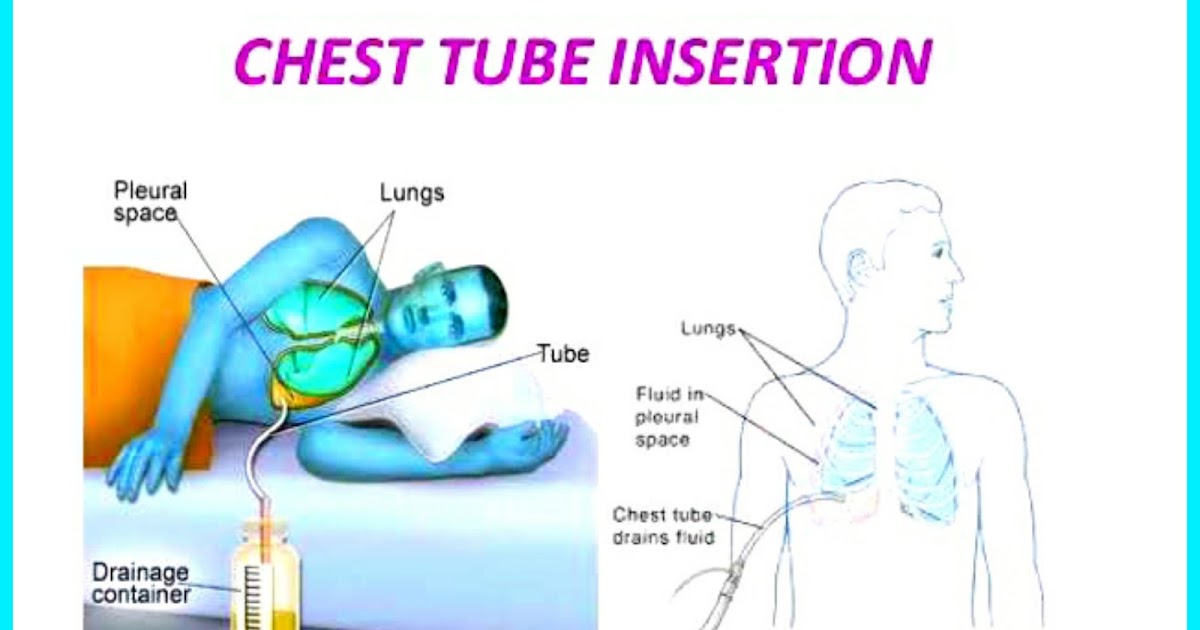 CHEST TUBE INSERTION AND MONITORING Nurses note help