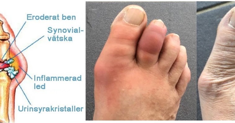 orsak till gikt