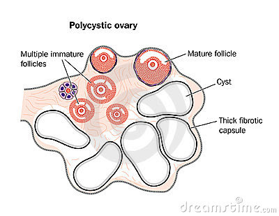 Polycystic Ovaries Treatment Natural Polycystic Ovaries Treatment Natural