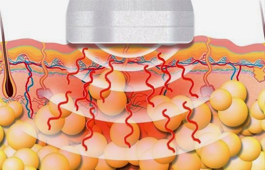 Cavitação - a lipo sem corte! A técnica derrete as gordurinhas através