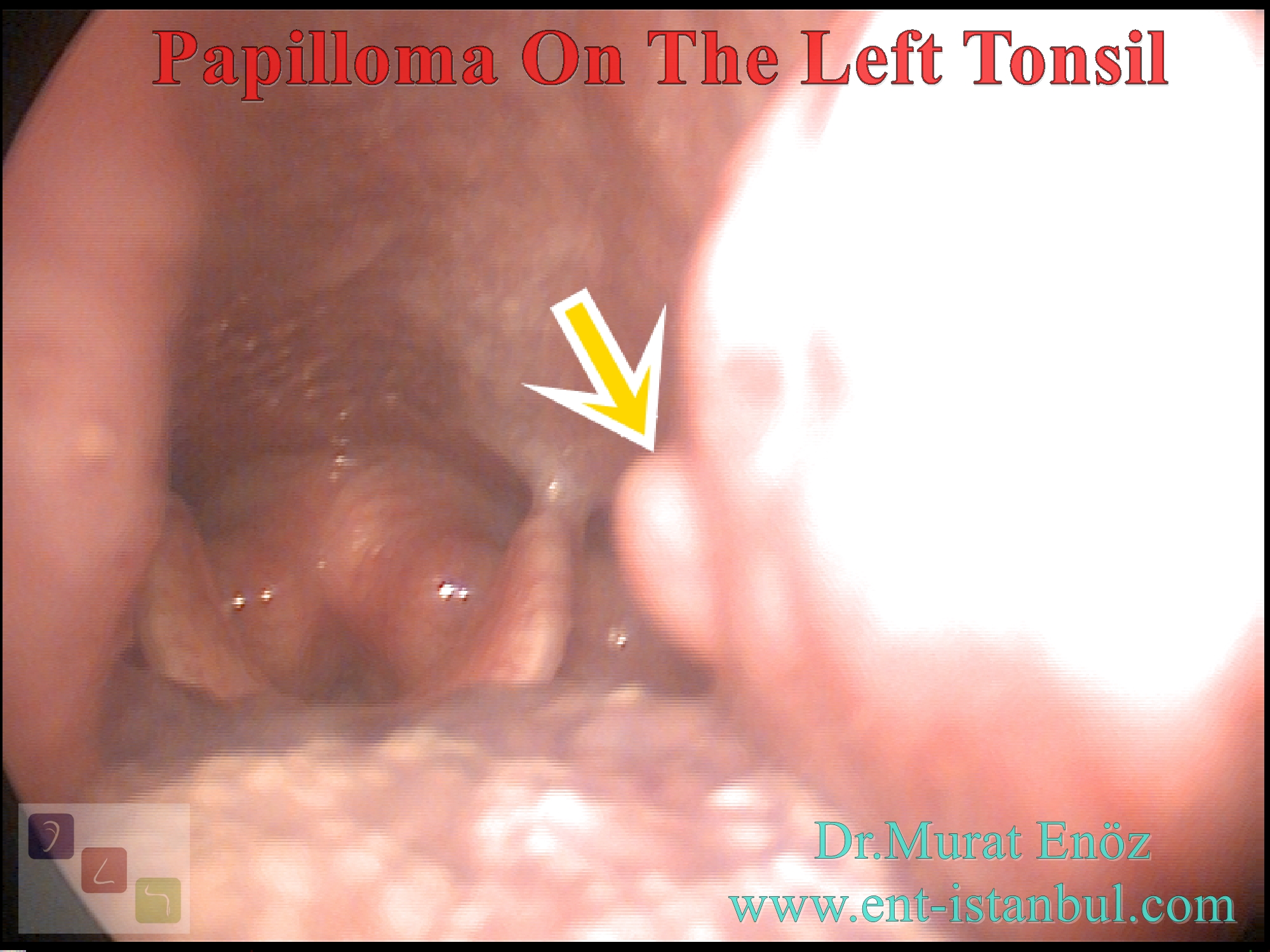 About Oral Human Papilloma Virus (HPV) Infections pic image photo