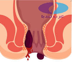علاج البواسير