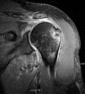 rotator mri dislocation traumatic resulting retracted surgery