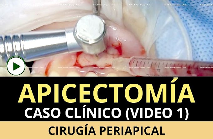 APICECTOMÍA: Cirugía Periapical - Caso Clínico (Video 1) - Carlos Fernando Ruiz Laos