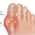 Best Homeopathic Doctor For Gout