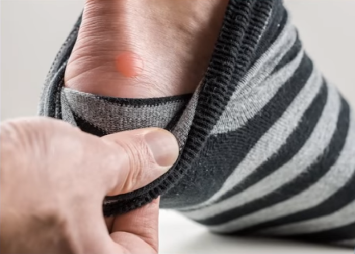 HOW TO DRAIN AND PREVENT A BLISTER HEALTH GUIDE 911