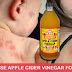 How To Treat Eczema Effectively And Naturally With Apple Cider Vinegar...