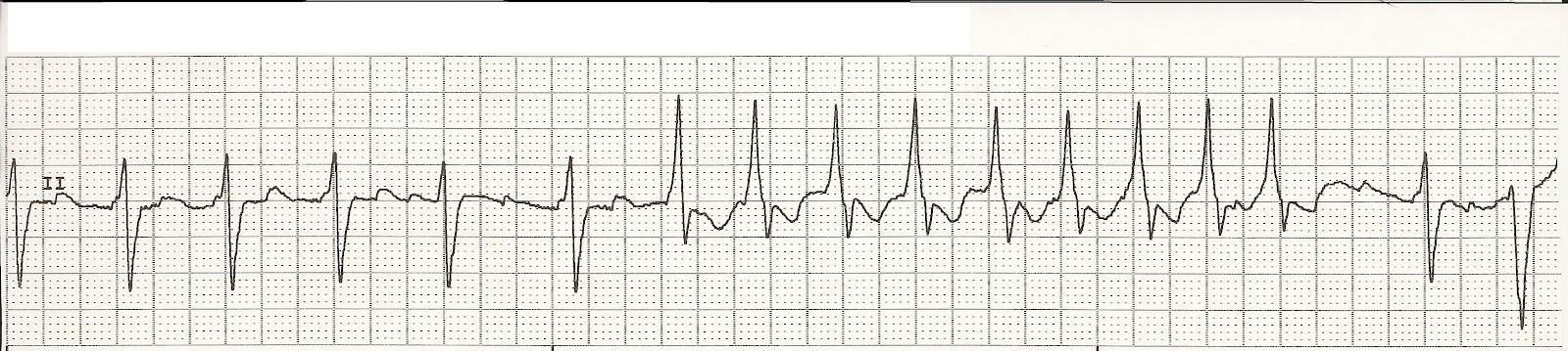 EKG Rhythm Strip Quiz 10