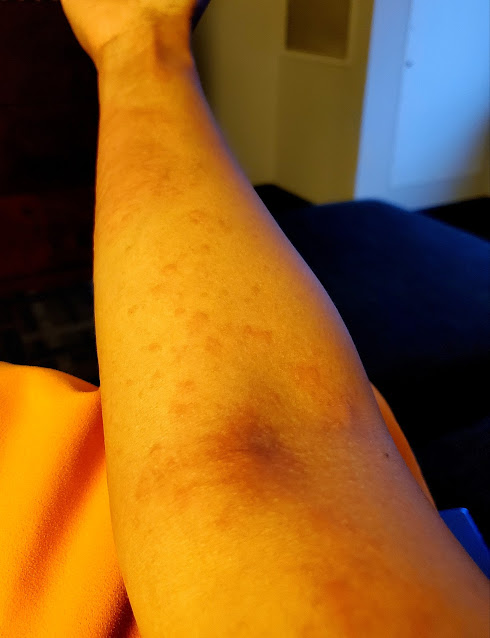 another pattern of rashes/hives