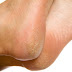 Best Home Remedies to Remove Foot Callus