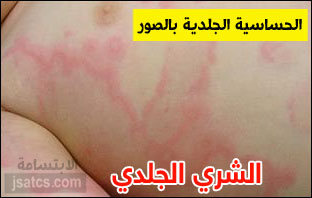 حساسية الجلد وانواعها بالصور والوصف الدقيق