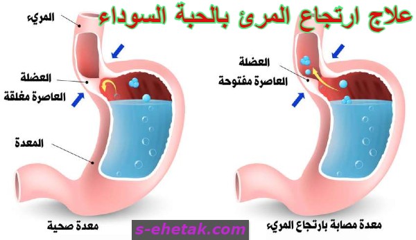 علاج ارتجاع المرئ بالحبة السوداء علاج ارتجاع المرئ بالحبة السوداء