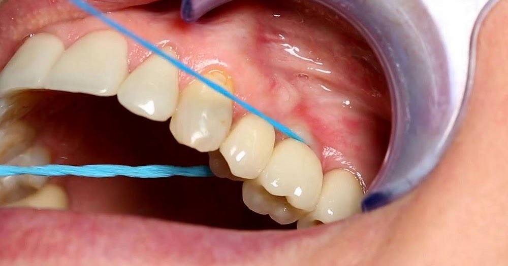 DENTAL IMPLANTS Cleaning Around Dental Implants for Oral Hygiene