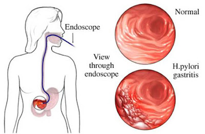 Obat Tradisional Gastroduodenitis