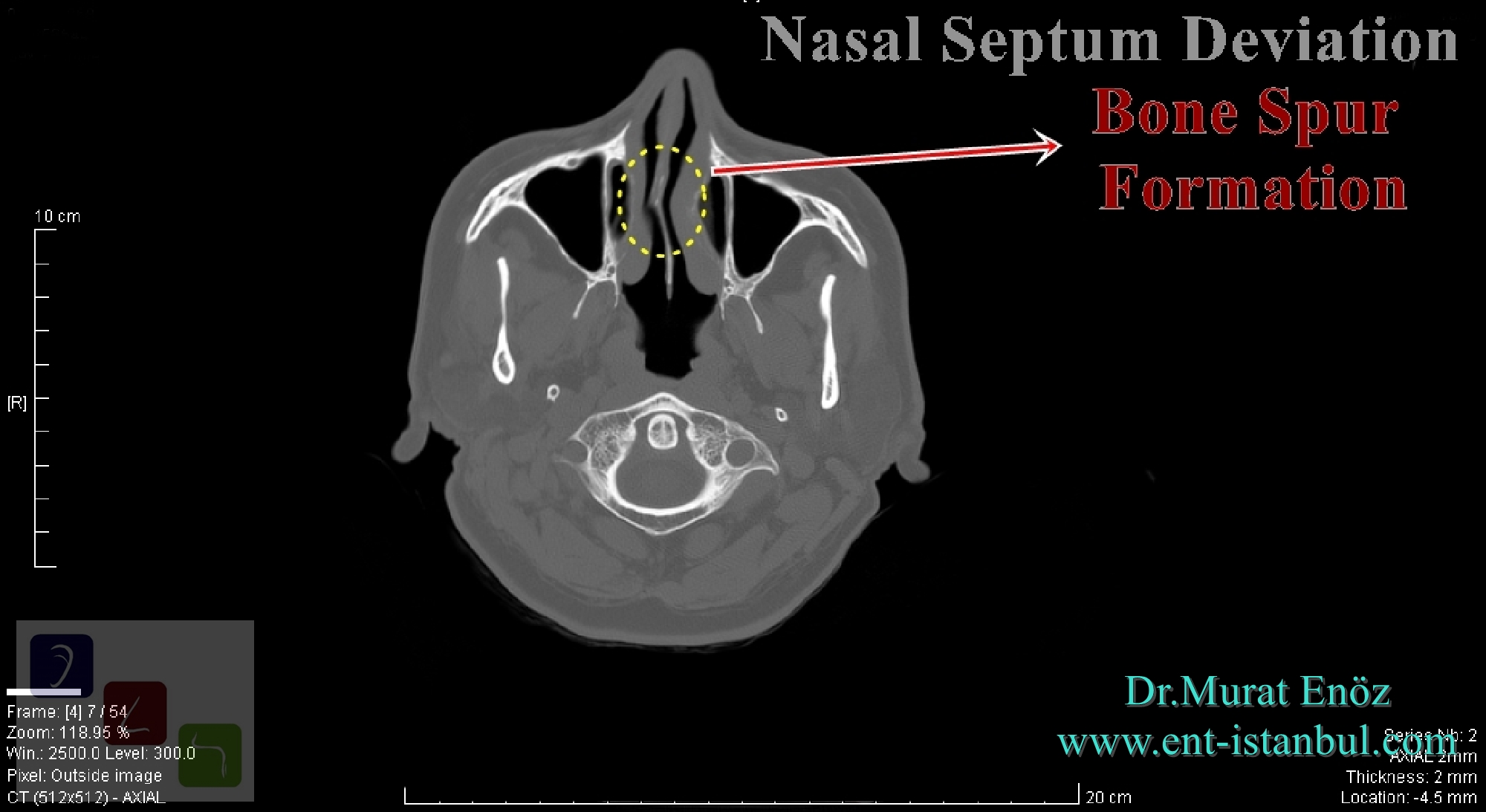 Treatment of Deviated Nasal Septum and Health Effects