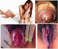 Foto Lubang Penis Mengeluarkan Nanah Serta Nyeri Ketika Buang Air Kencing