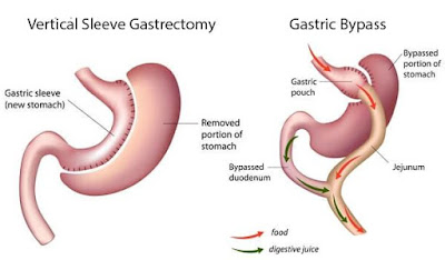Bariatric Surgery Vertical Sleeve VSG Gastric Bypass RNY