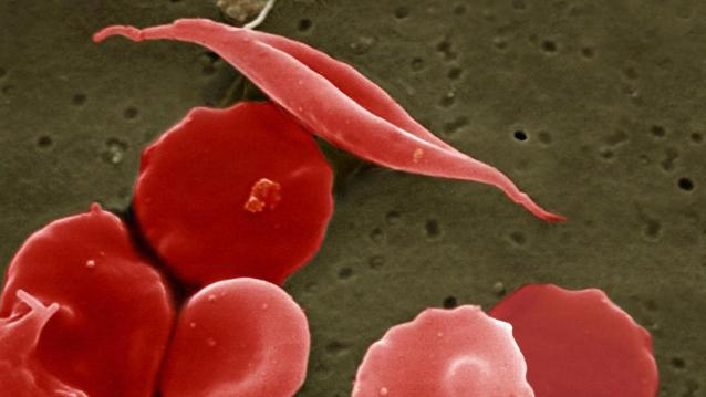 NIH researchers create new viral vector for improved gene therapy in sickle cell disease