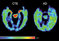 Demensia CTE, Tidak Seperti Alzheimer, Dapat Didiagnosis Secara Definitif