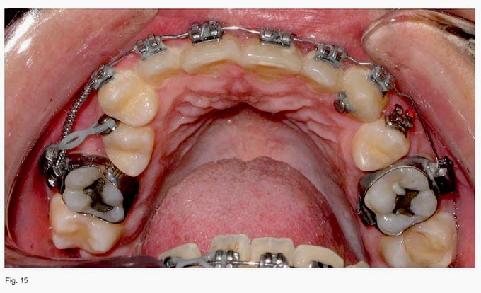 PDF: Aplicaciones Periodontales a Ortodoncia - Regeneración tisular guiada