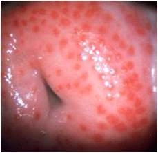 Genital Warts Pictures | HPV Photos in Men and Women