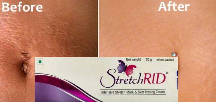 stretchrid cream