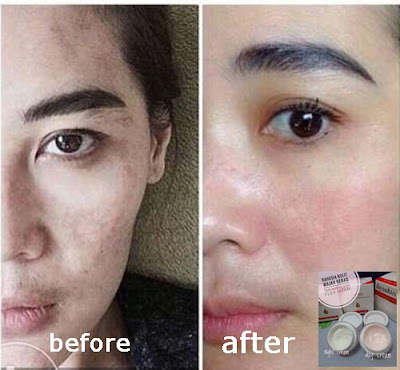 Cream Penghilang Flek Hitam Akibat Genetik/Keturunan Liyoskin Cream Penghilang Flek Hitam Akibat Genetik/Keturunan