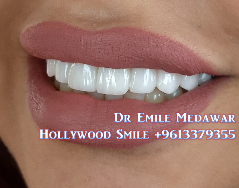 emile medawar veneers beirut implant