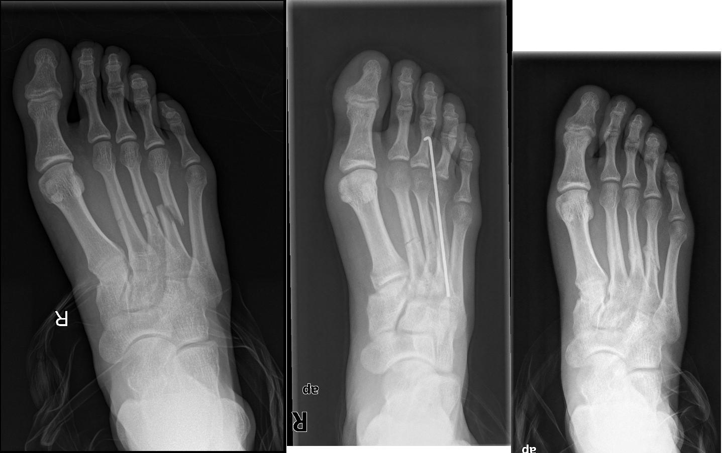 Fanáticos del pie ATLAS DE PATOLOGÍA DEL PIE FRACTURA DE METATARSIANOS