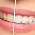 Sono i denti naturalmente gialli? Esistono denti bianchi naturali?