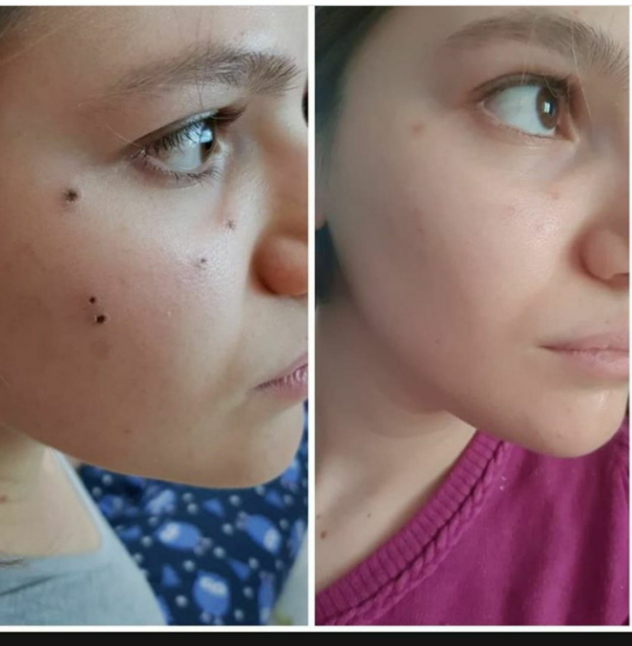 Öncesi/Sonrası Fotoğrafları Bitkisel Ben Silme Kremi Ameliyatsız