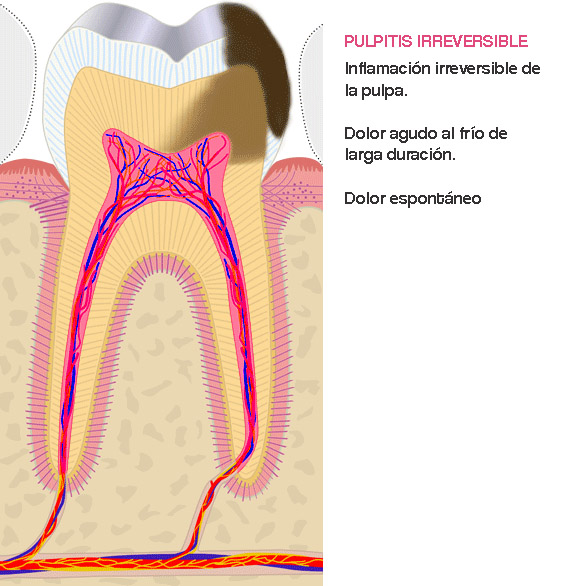 Entendiendo mi sonrisa Pulpitis Reversible e Irreversible Entendiendo mi sonrisa Pulpitis Reversible e Irreversible