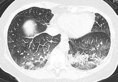 Diffuse pulmonary hemorrhage