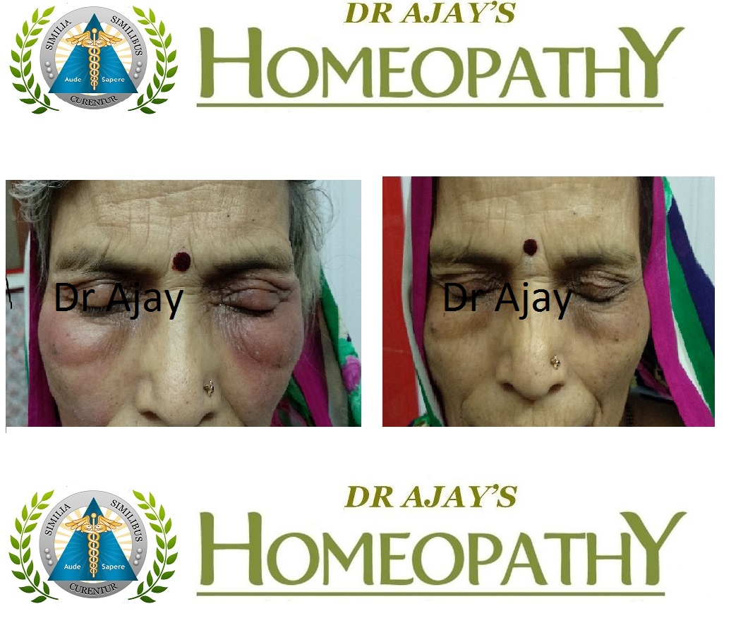 Dr Ajays Homeopathy Homeopathy best for Under Eyes Bags & Puffiness