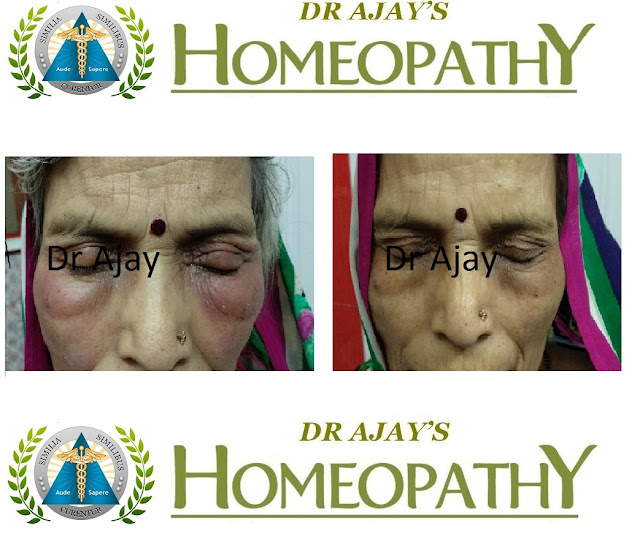Dr Ajays Homeopathy Homeopathy best for Under Eyes Bags & Puffiness