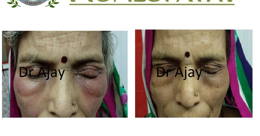 What Causes Purple Bags Under Eyes