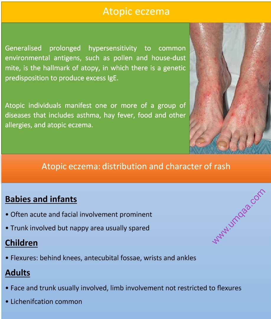 What are the diagnostic criteria for atopic eczema?