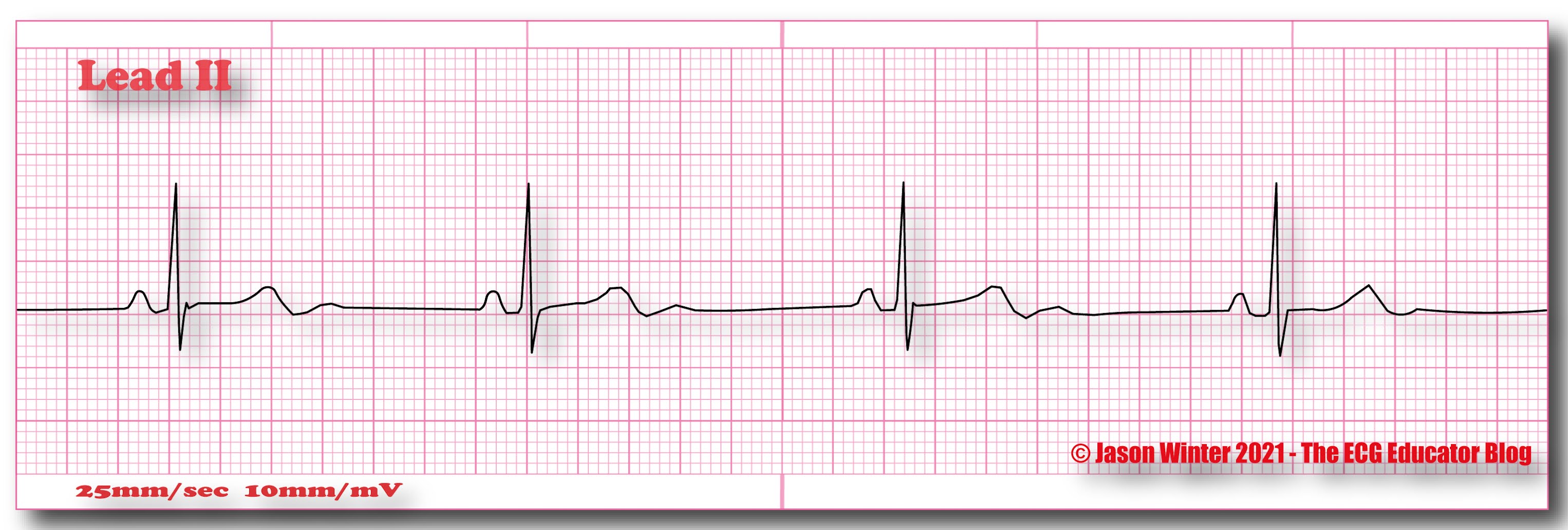 Sinus Arrhythmia Rhythm Strip sinus-arrhythmia-rhythm-strip