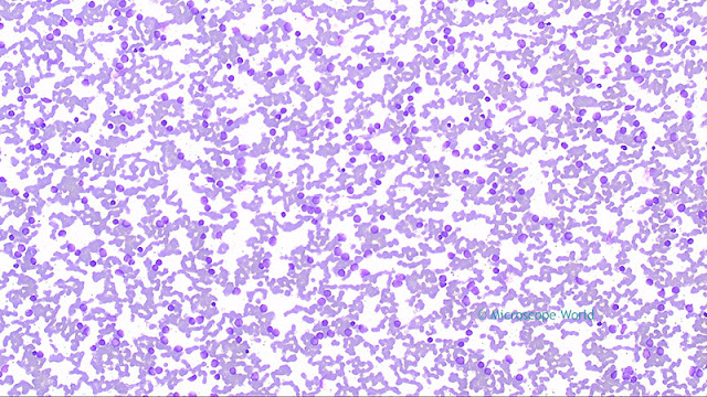 Microscopy image of Leukemia captured with a lab microscope at 100x.