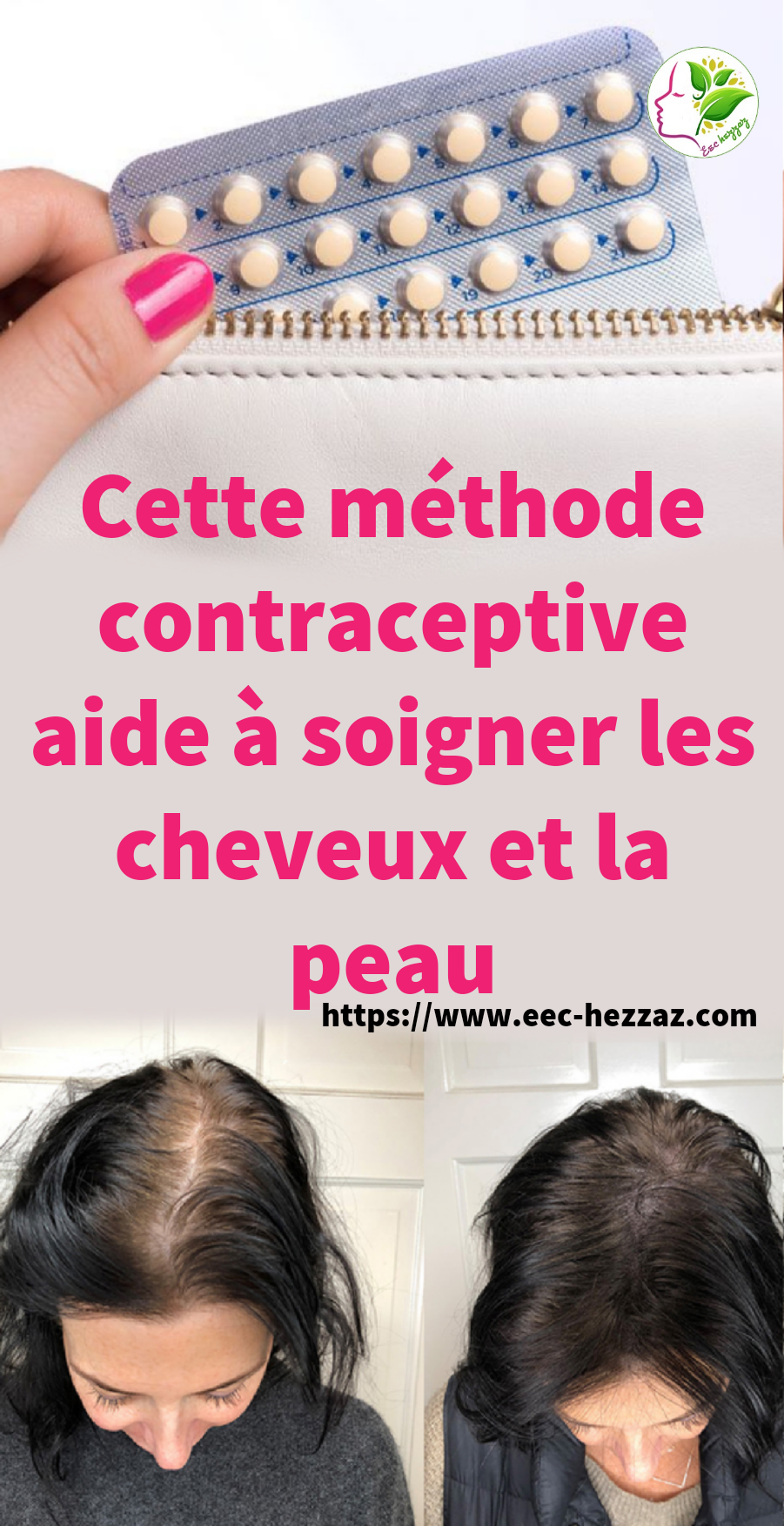 Cette méthode contraceptive aide à soigner les cheveux et la peau