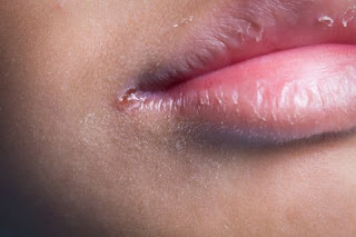 causes of cold sores 