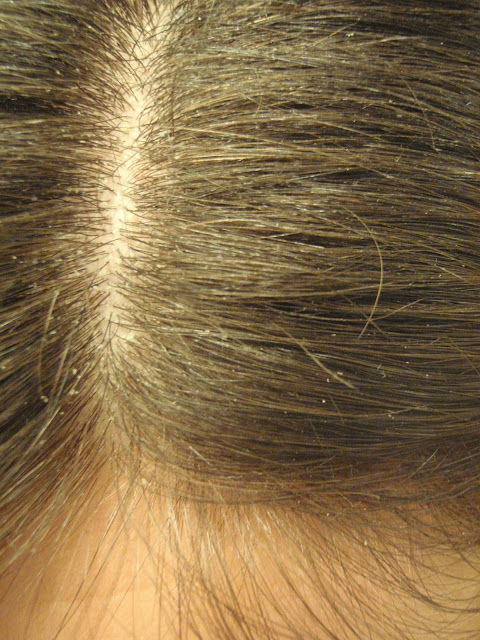 Dry scalp or dandruff