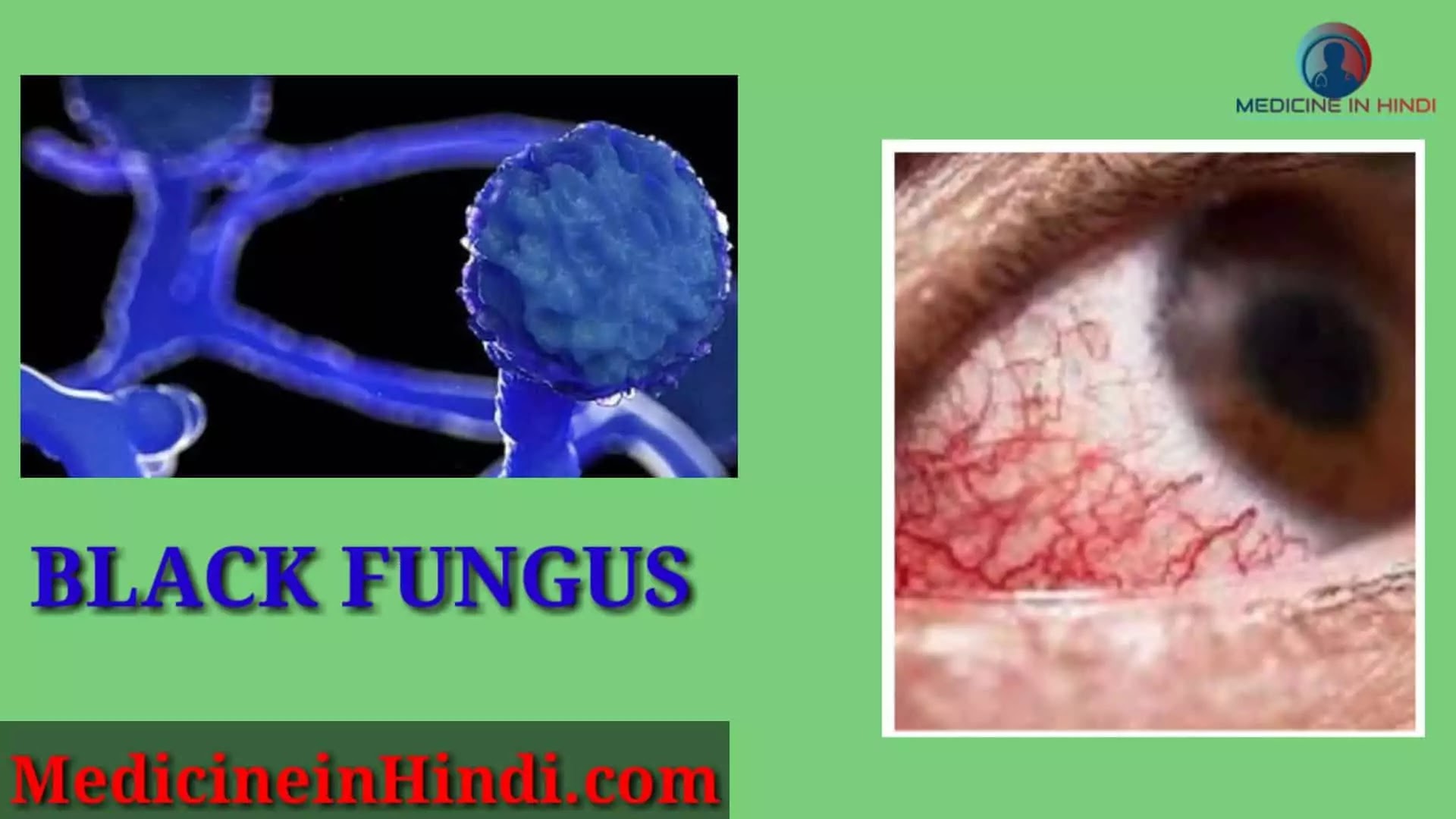 Black fungus disease symptoms in Hindi | black fungal disease causes in Hindi |