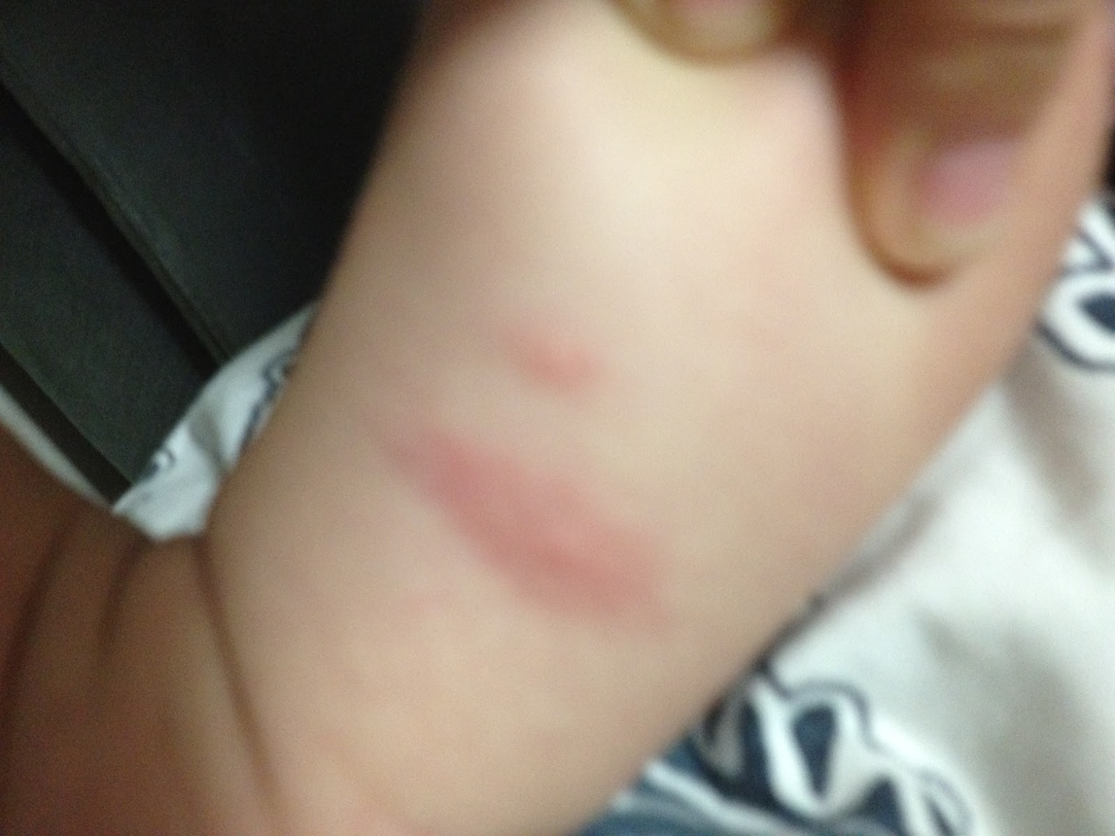 hello-bunny-baby-mosquito-bites
