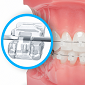 Các loại mắc cài niềng răng phổ biến nhất hiện nay