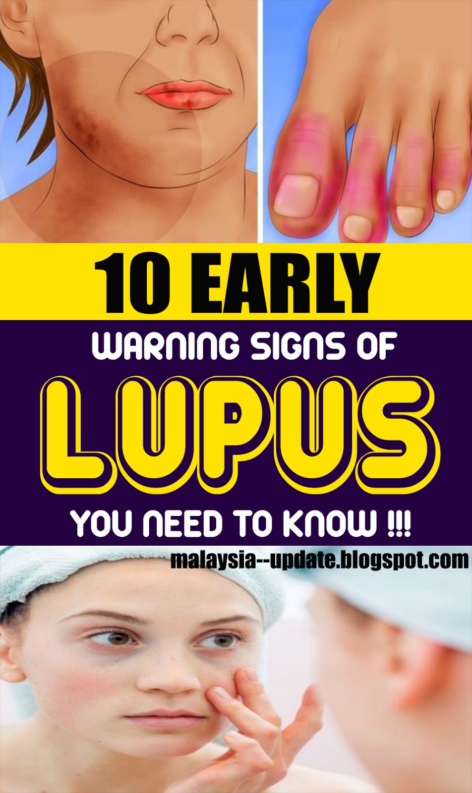 10 Early Warning Signs of Lupus You Need to Know