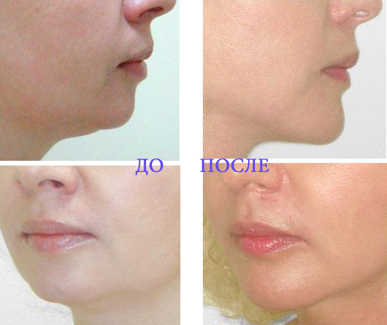 сколько держится липофилинг