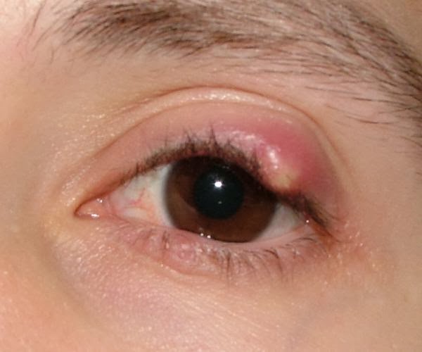 Diveeksha Eye Clinic Chalazion