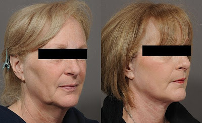 El rejuvenecimiento facial